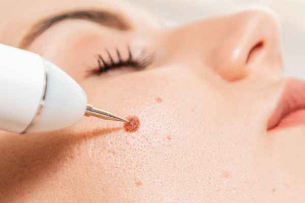 CryoPen: 5 Skin Concerns It May Be Used to Treat 3 What actually happens during a CryoPen treatment Busby?