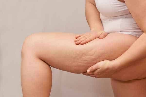 Find the best cellulite treatment Busby for you!