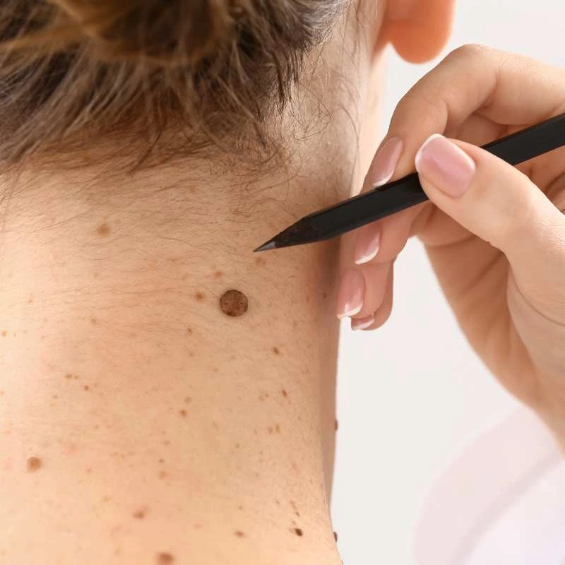See our lesion removal prices Busby - call today for a free quote