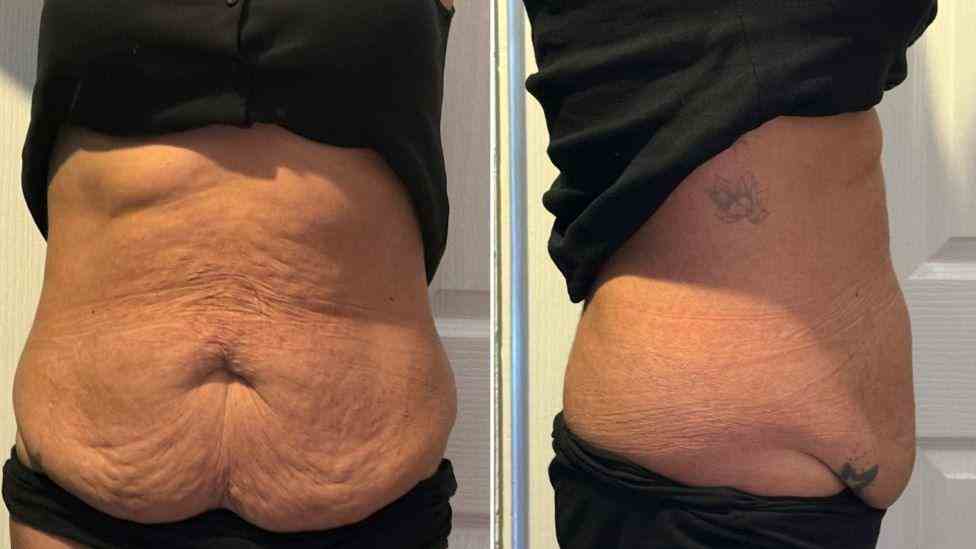 Lost the Weight but Not the Loose Skin? What You Should Know 1 Is It Definitely Loose Skin Busby?