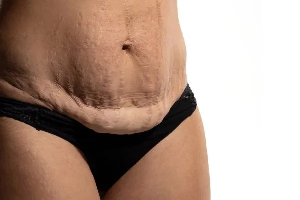 image of womans stomach after weight loss showing loose skin Busby 