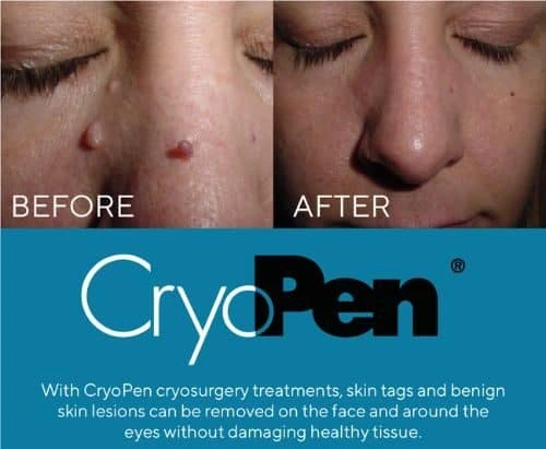 image of angiofibroma removal Busby using Lipo Sculpt cryopen!